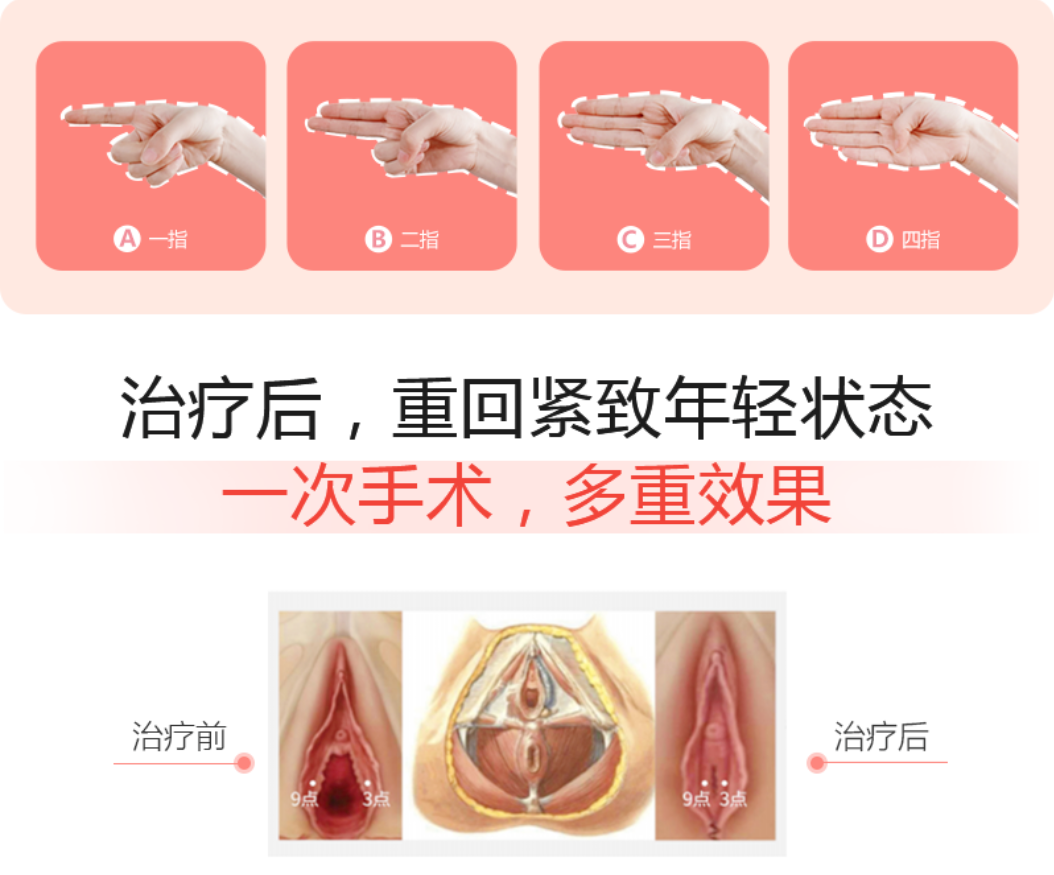 松弛、漏尿太尴尬？3D生物束带紧缩术帮你收“紧”负距离的幸福